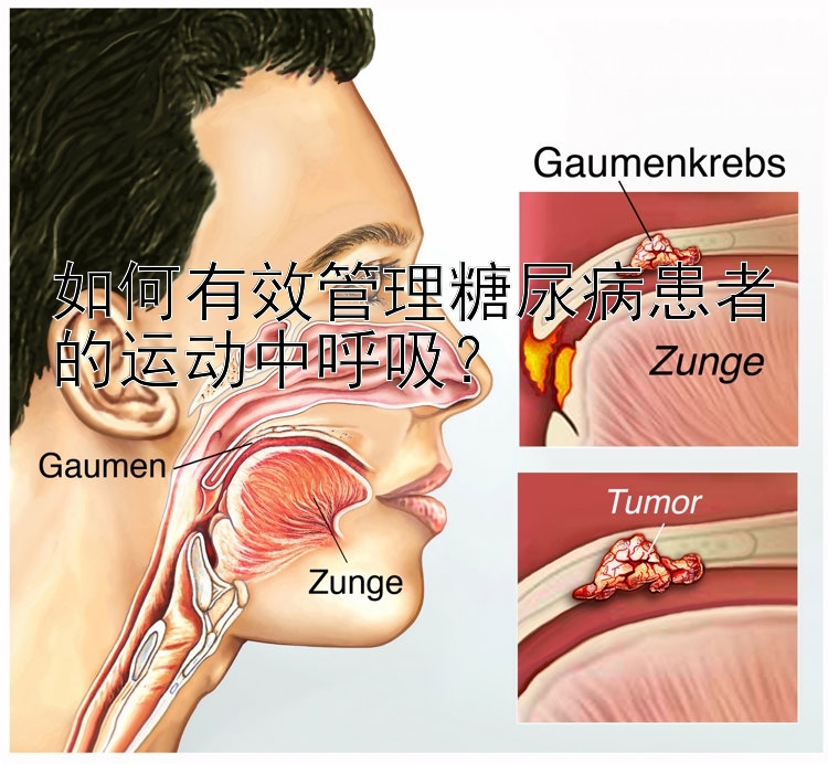 如何有效管理糖尿病患者的运动中呼吸？